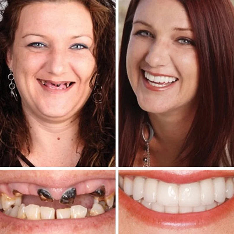 🦷🍎Heat and Fit ROSOPLTM – Immediate Dentures: The Ultimate Fit You Can’t Resist!  (👩‍🔬Certified | Dentist Approved)