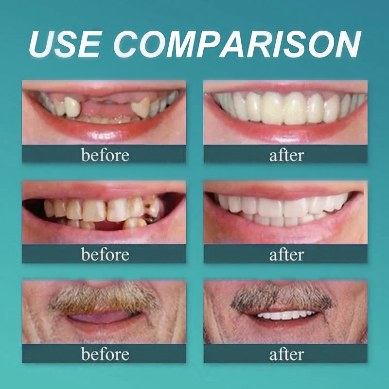 🦷🍎Heat and Fit ROSOPLTM – Immediate Dentures: The Ultimate Fit You Can’t Resist!  (👩‍🔬Certified | Dentist Approved)